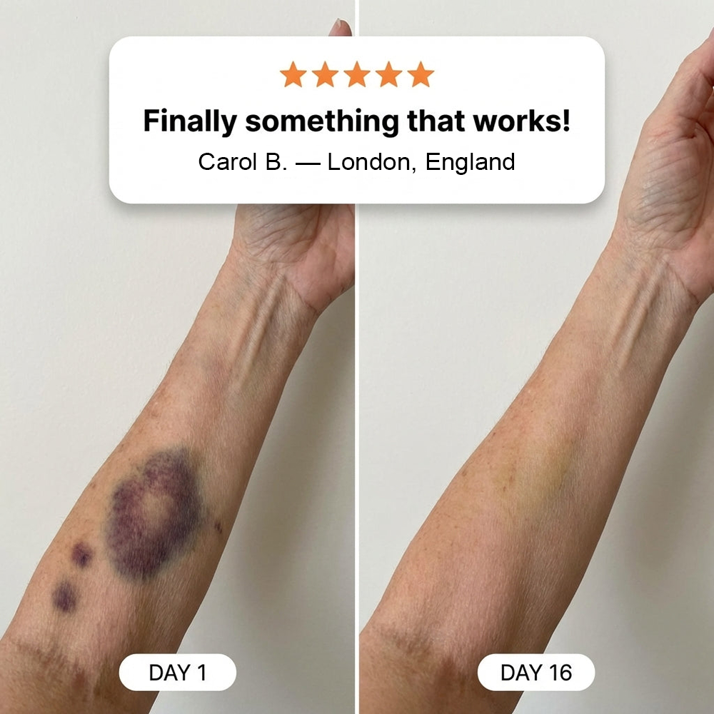 💥100K+ SOLD💕- PURELORA® Bruise Repair & Skin-Strengthening Cream